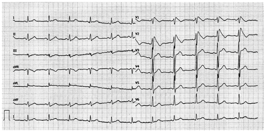 患者|这个房颤患者，让医生直呼“太惨了”……
