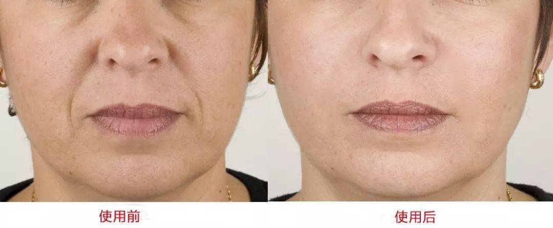 皱纹|抗皱抗衰老还在打针?用它赶走三八脸、鱼尾纹,让小朋友见到你都喊姐姐!