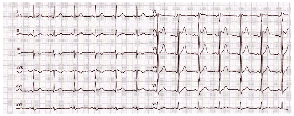 患者|这个房颤患者，让医生直呼“太惨了”……