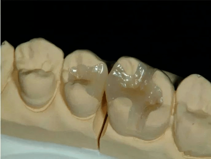 牙体缺损的另类补牙——嵌体修复_牙齿