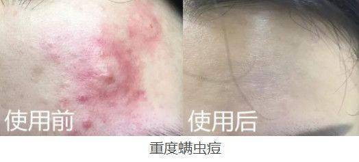 肌肤|脸上挤出的“白浆”是什么？原来是它作怪！出油、过敏也因此而起！