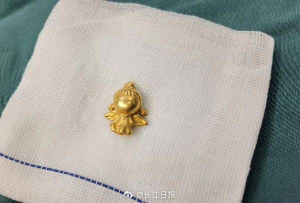 医生|幸好医生取出来了9个月的“吞金兽”真的吞下个“金宝宝”