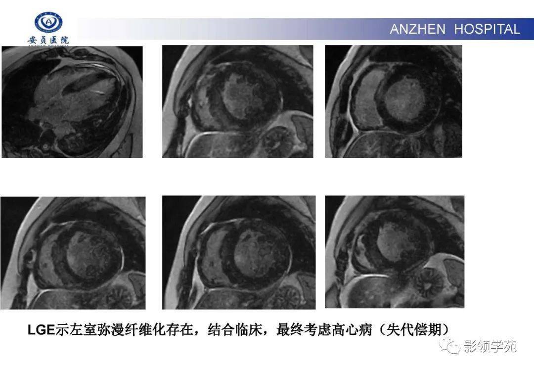 cmr对肥厚型心肌病的鉴别诊断