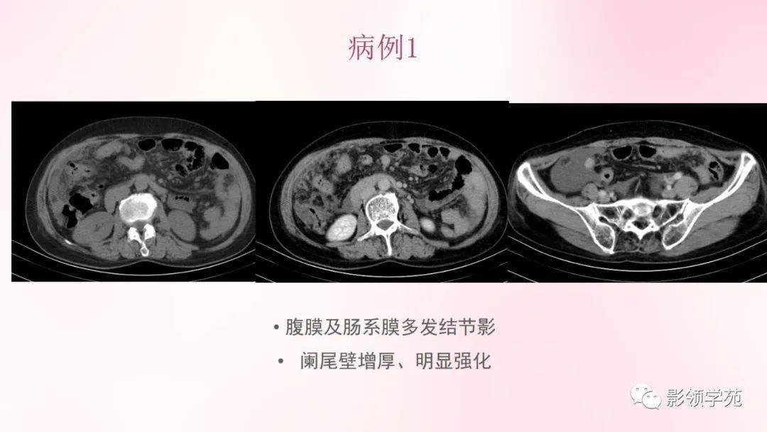 膜及肠系膜病变的影像学表现