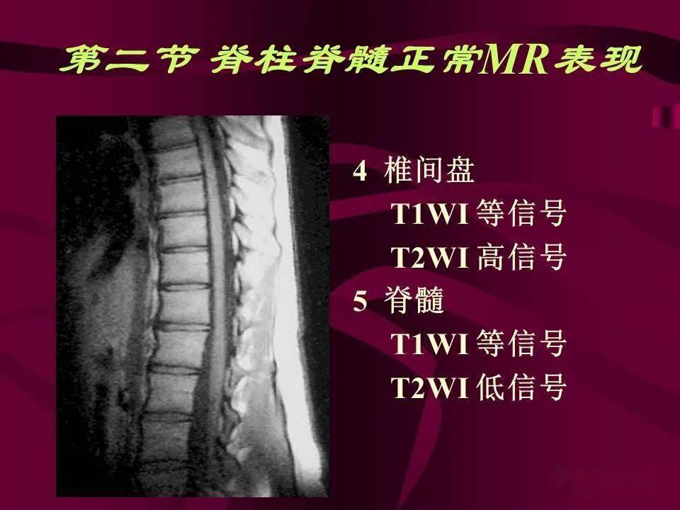 脊柱和脊髓病变mri诊断