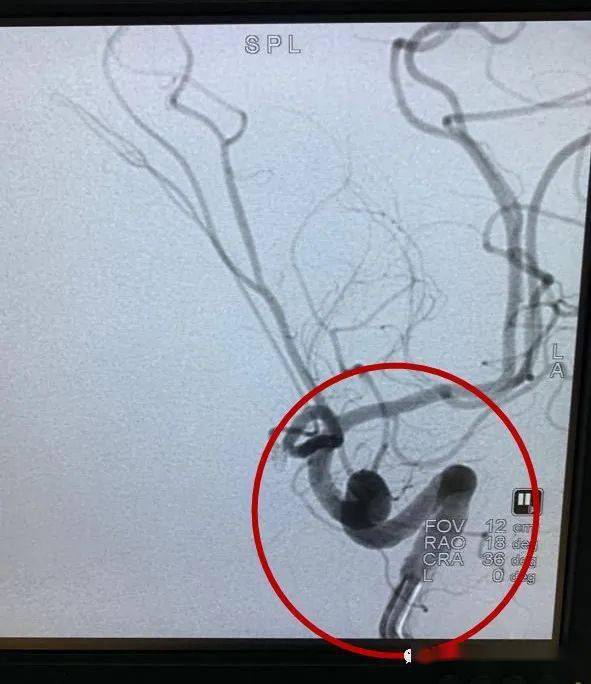 什么是动脉瘤性蛛网膜下腔出血 726242d6e58d4401a2b2177051a0ac87.jpeg