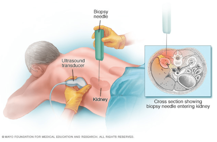 疾病|关于慢性肾脏病，你想知道的都在这里