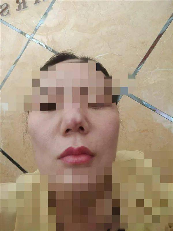 "死的心都有!"女子隆鼻整容变毁容,称"副院长"在小区做的手术