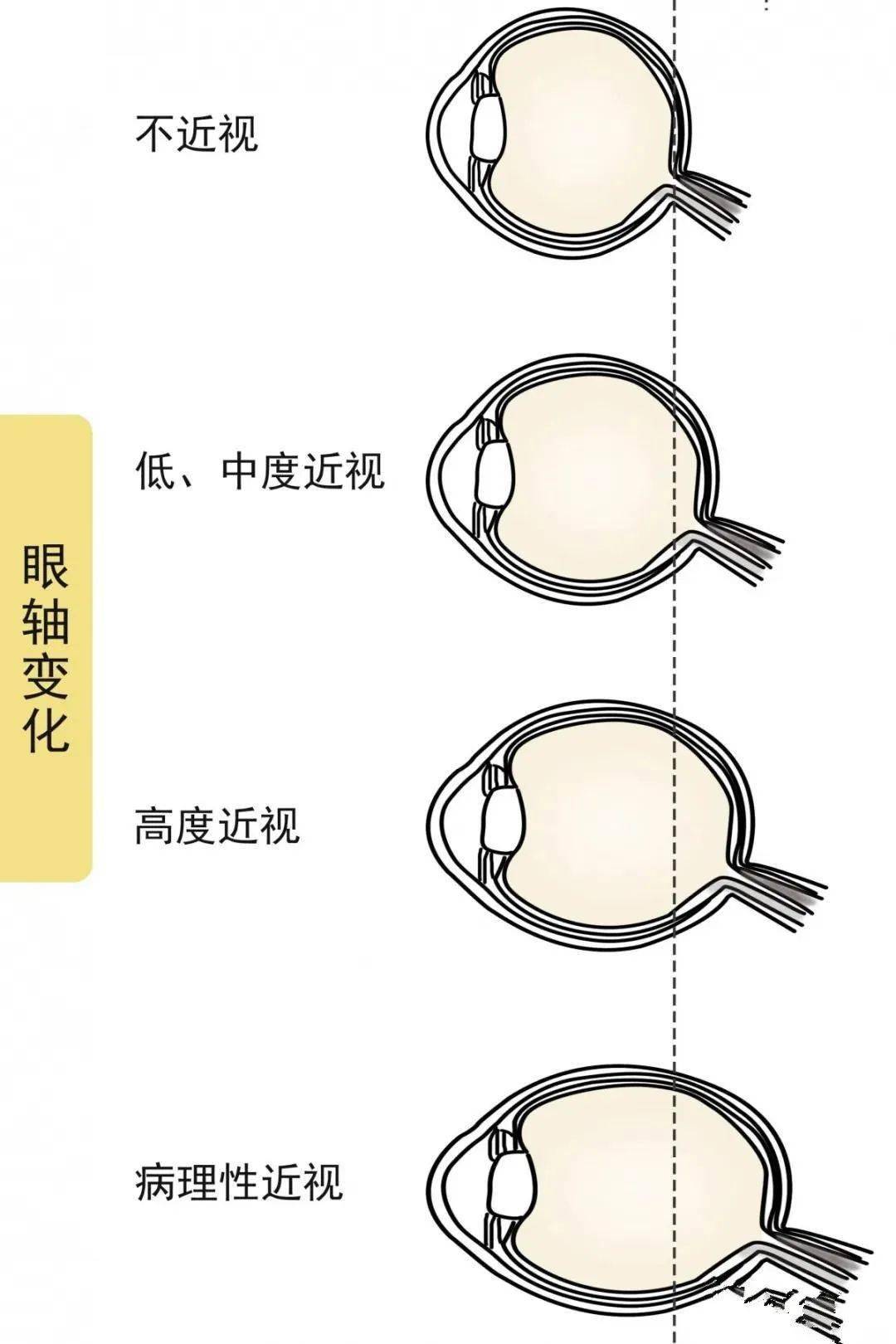 有关近视眼的3个发展阶段你知道多少