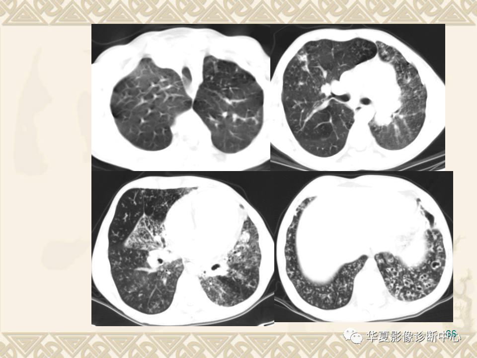 影像基础课丨肺气肿及气道疾病的影像学表现