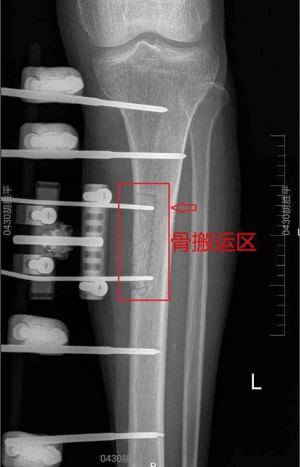 手术|【专家在身边】右足溃疡坏死，骨科手术竟然还做了左腿？专家这样解释……