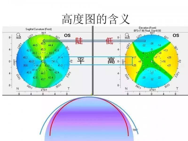 地形图用正值表示61规则散光角膜是一个复曲面马鞍形,在子午线方向
