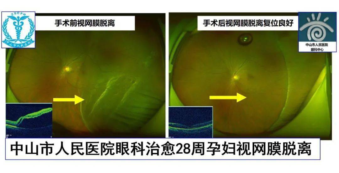 孕妇视网膜脱离!一场手术让危险与担忧化解