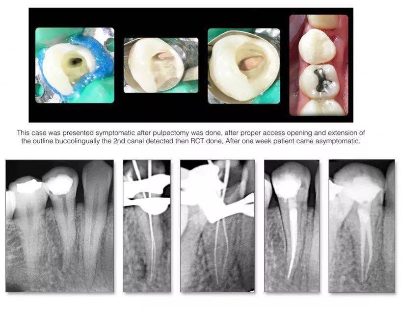 【牙医学堂】下颌前磨牙:多样化的根管解剖