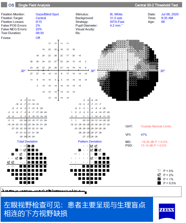 双眼视盘视神经分析报告