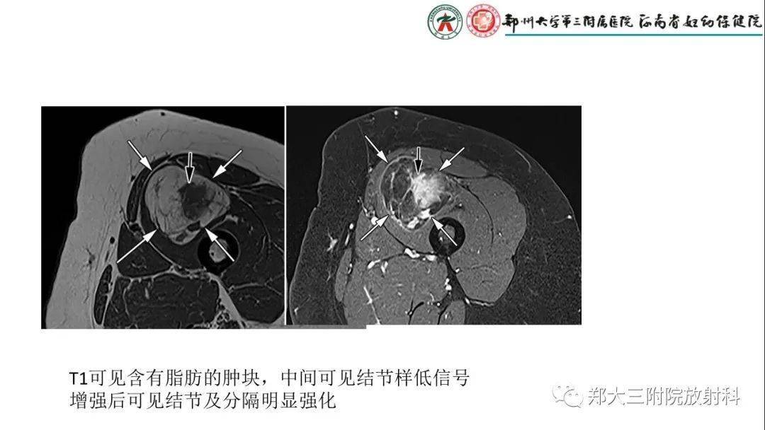 脂肪母细胞瘤的影像诊断