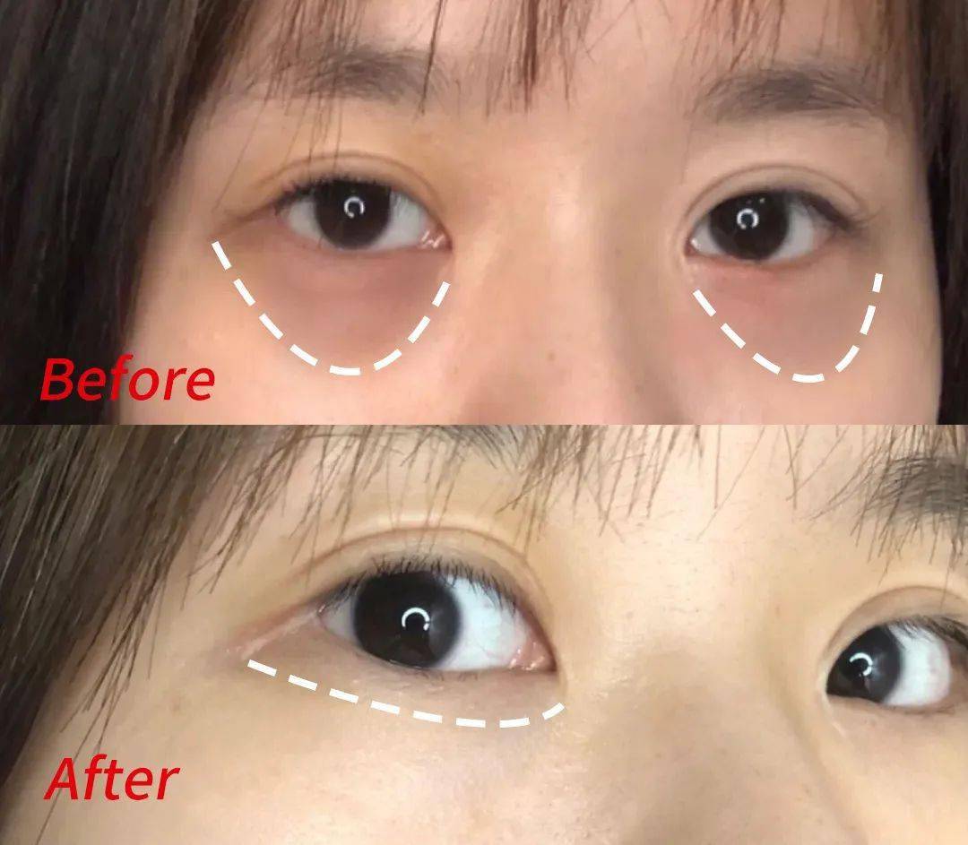 黑眼圈|blingbling大眼秘诀！早晚滚两下，赶走黑眼圈、细干纹！