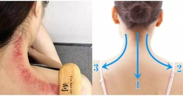 可以用什么东西刮痧 be1c93b609794dad9d35deda9ee78519.jpeg