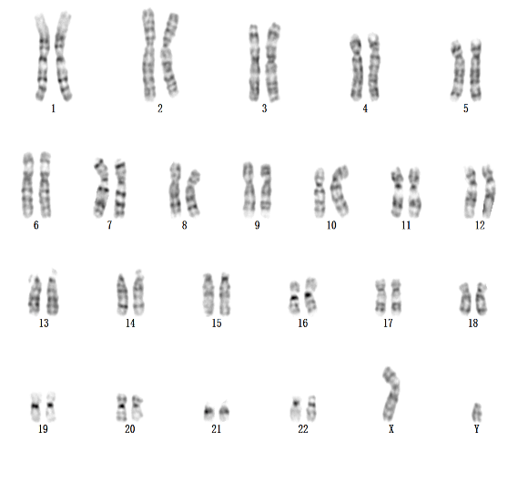 dyz1) 可见一个绿色x信号(正常x)染色体,两个红色y信号(双着丝粒y),无