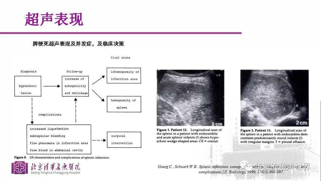 病例与文献复习:脾脏急诊之脾梗死