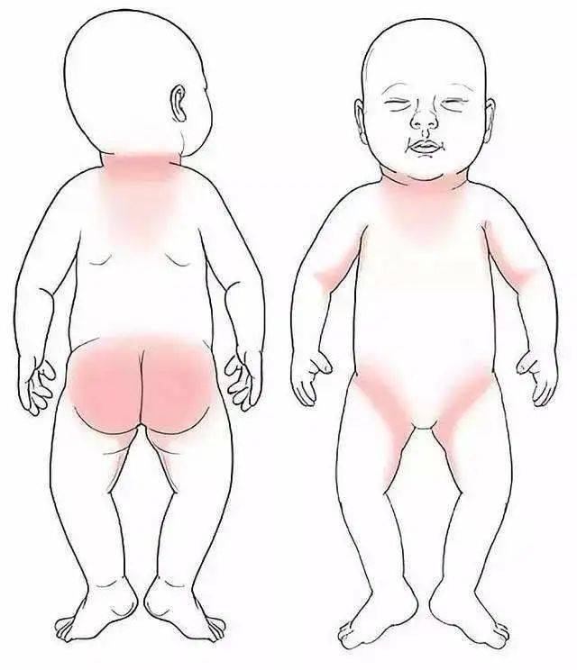 老长|家长们快收藏!孩子身上老长痱子怎么办?医生提出五个建议