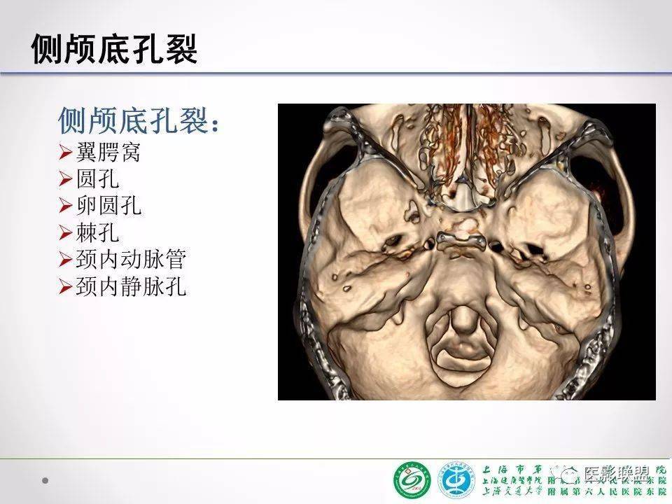 侧颅底临床解剖和影像
