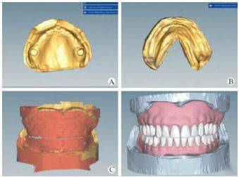 病例分享数字化全口义齿三维笑设计一例