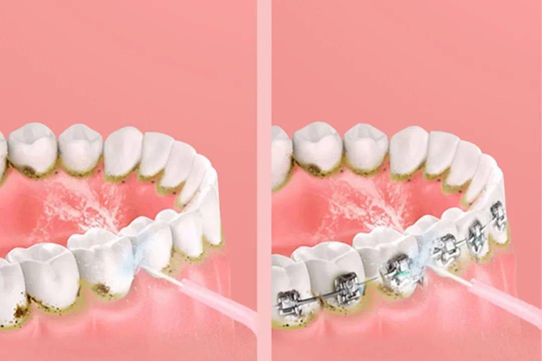 食物残渣|到底有多重要？你有一口好牙