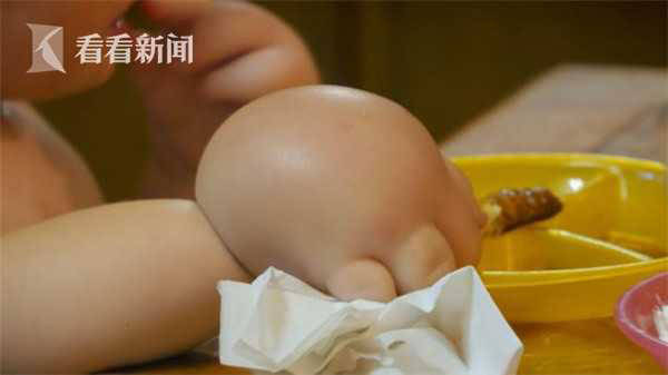 淋巴|2岁“金刚芭比”双手肿成拳套 孩子出生就患怪病