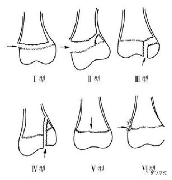 骨骺损伤分型
