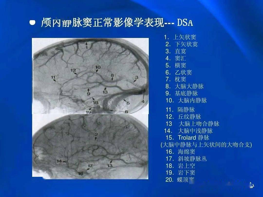 颅内静脉窦血栓形成的影像学表现