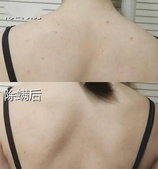 痘痘|背上长痘？神奇“液体”硫磺皂，60秒揪出万千螨虫，李佳琦卖了3万瓶！