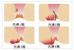 "痔疮"突然长大是怎么回事?_肛门