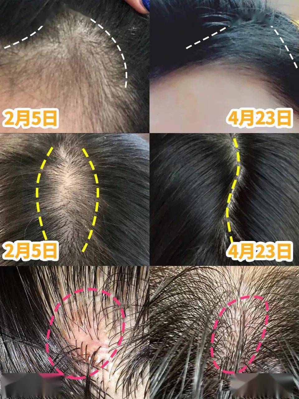 滋养液|32年才做成的育发液!让你挑战30天+生出小绒毛