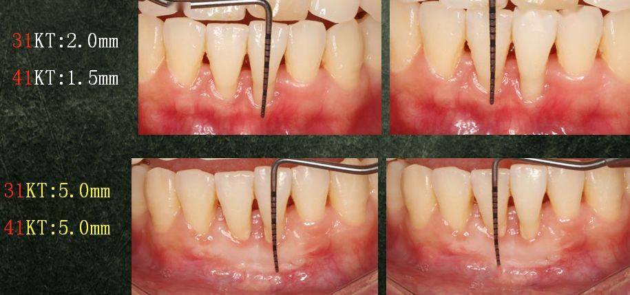 局限型侵袭性牙周炎及牙龈退缩治疗病例分享