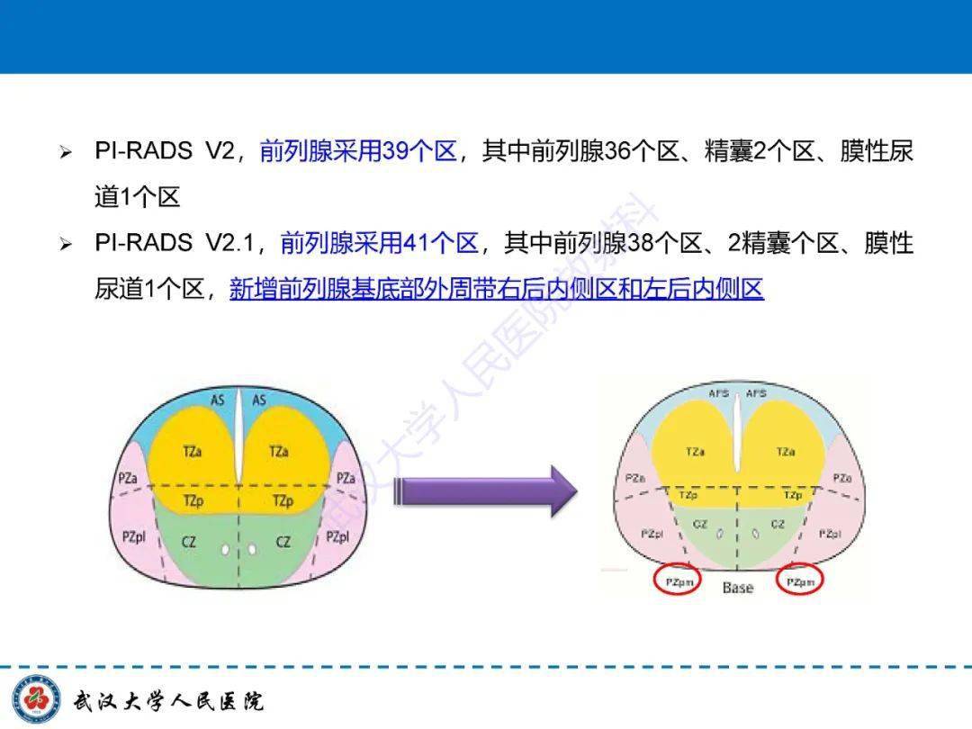 推荐 前列腺pi-rads 2.1版本更新解读