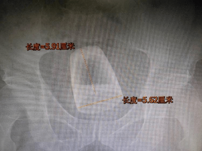 肛门|医生在直肠里找到了啤酒杯、罗非鱼、茄子、灯泡、泥鳅.....