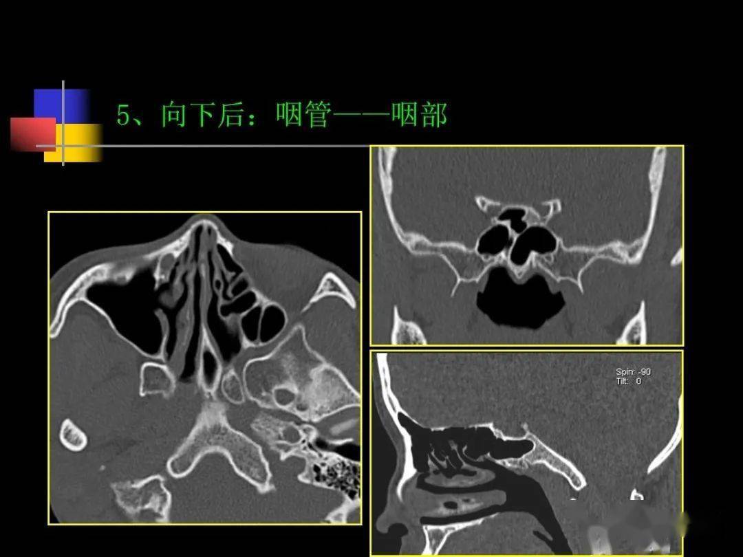 鼻咽部ct解剖