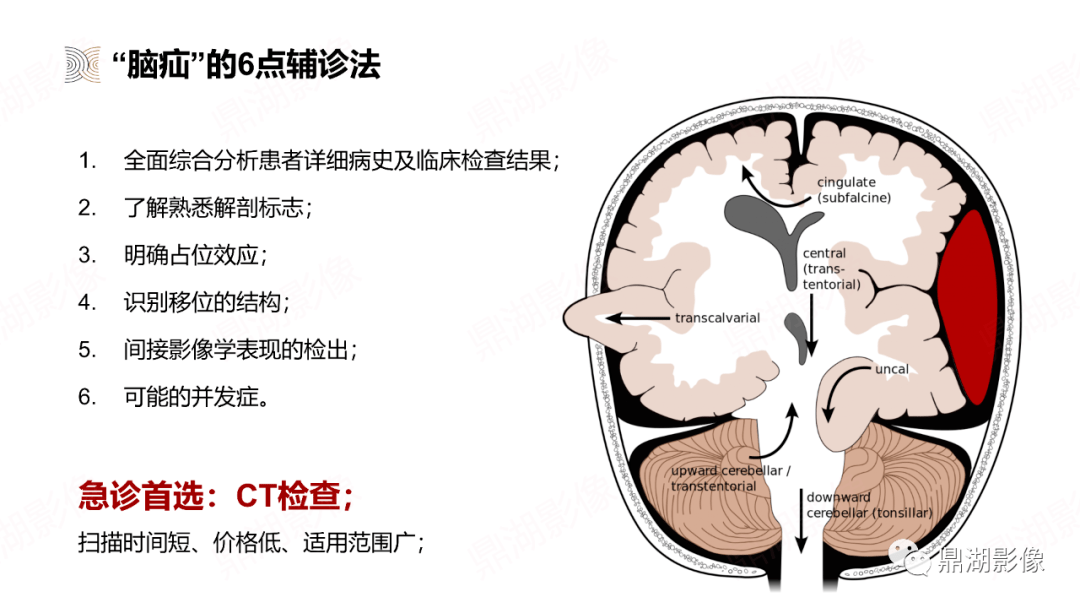 图解脑疝分类及影像学特