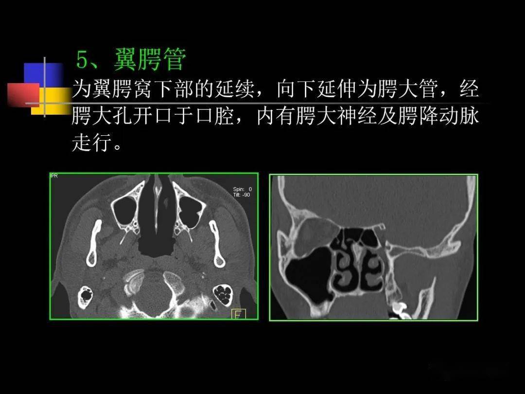 鼻咽部ct解剖