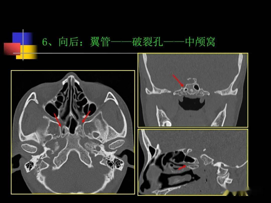 鼻咽部ct解剖