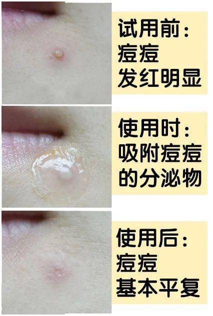 痘痘|“拔”出黄脓，快速消痘！让肌肤变成“白煮蛋”，就是这么简单！