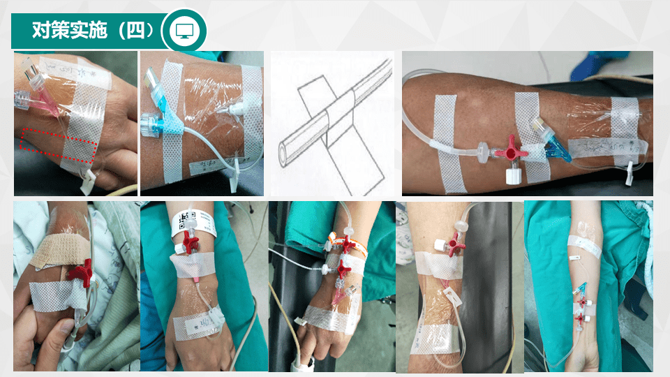 【ppt资源】手术室静脉留置针局部皮肤护理