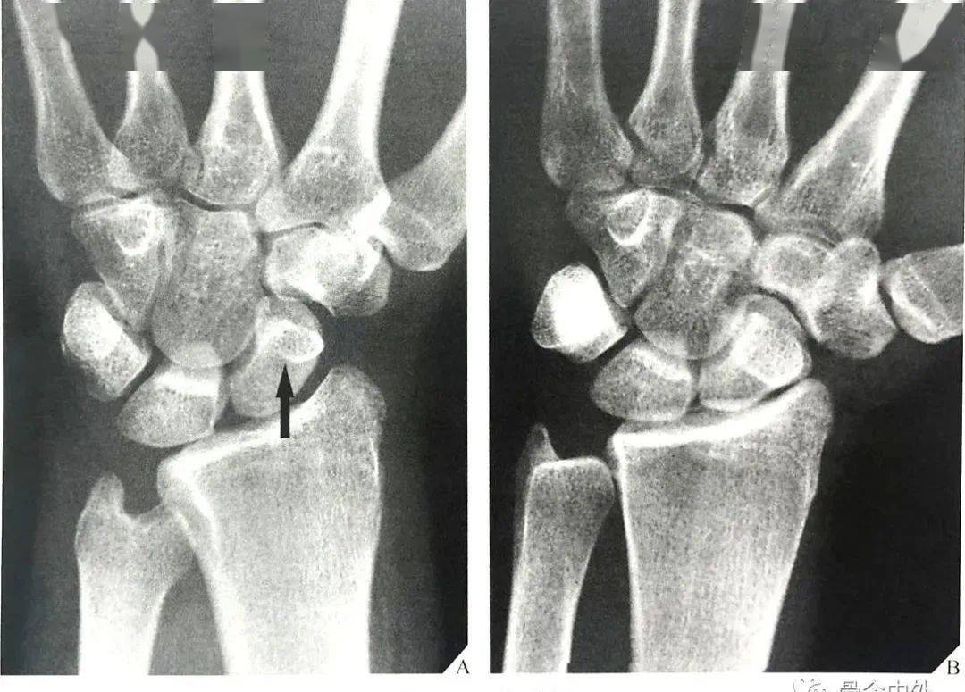 腕关节脱位及其x片阅读技巧