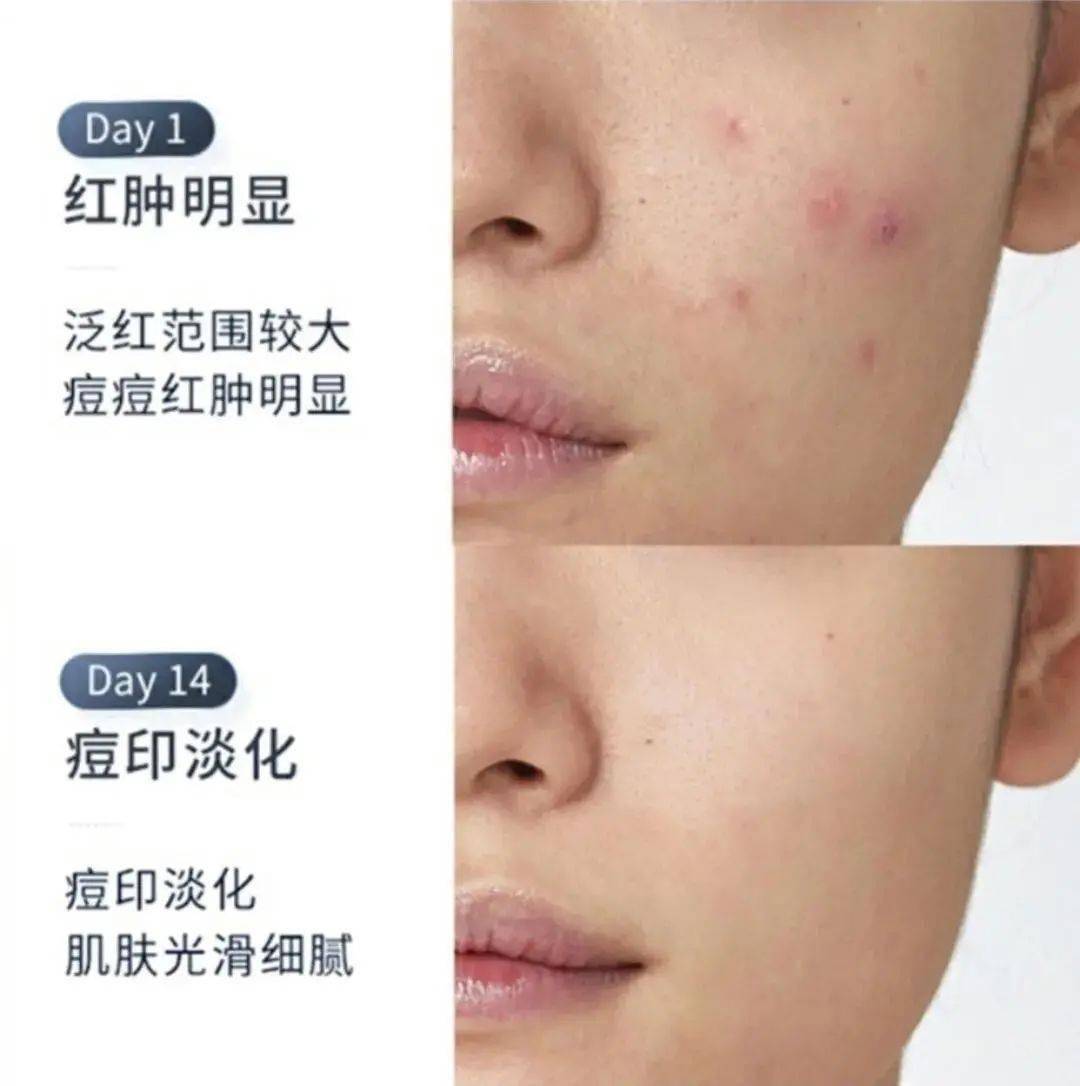 贫民窟|杨幂熬夜后护肤要花2万块？怪不得皮肤吹弹可破！贫民窟女孩就不配消除熬夜痘、黑眼圈吗？