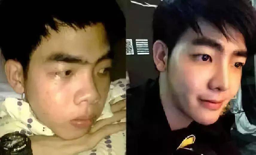 生活|泰国小哥花15万整形，成功从屌丝逆袭变男神！