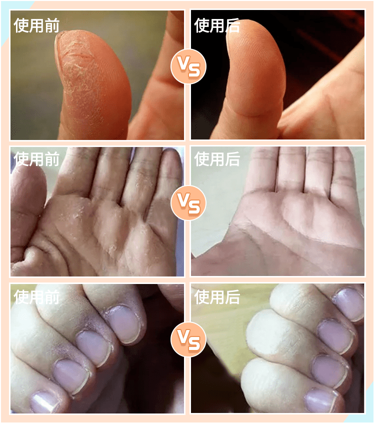 肌肤|因为粗糙的手,丢了颜值还越来越自卑,还好有它拯救了....