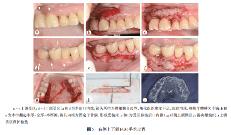 双侧上下后牙种植修复后应用游离龈移植术改善软组织条件利于健康维护