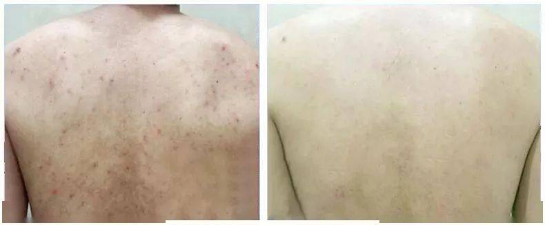 痘痘|夏天变黑长痘不可怕，赶紧用它，让你的皮肤恢复婴儿的光滑，痘痘，黑头，螨虫全都消失了