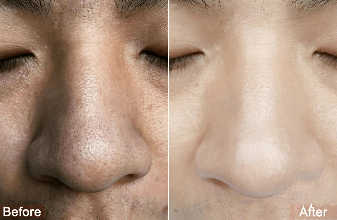 痘痘|夏天变黑长痘不可怕，赶紧用它，让你的皮肤恢复婴儿的光滑，痘痘，黑头，螨虫全都消失了